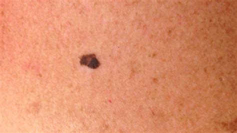melanoma skin cancer icd 10